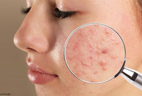hormonal breakouts on chin