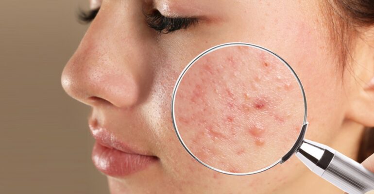hormonal breakouts on chin