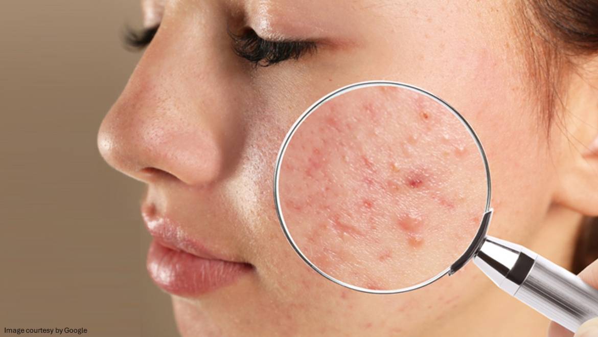 How to Treat Hormonal Acne?