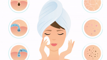 Effective Home Remedies for Acne