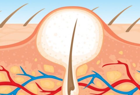 fungal acne