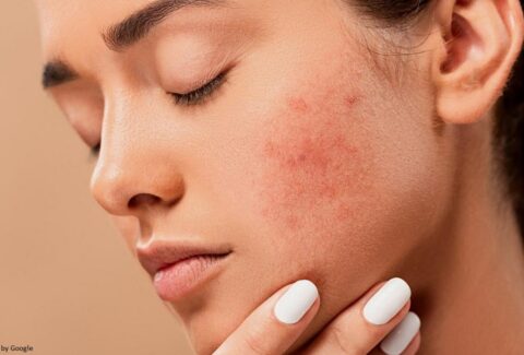 home remedies for pimples