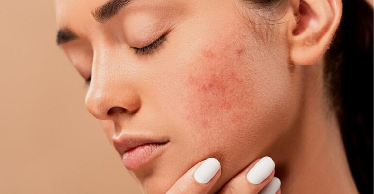 home remedies for pimples