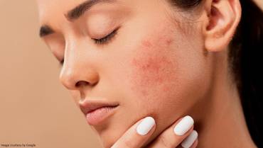 Effective Home Remedies for Acne