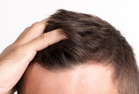 hair loss