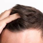 A New Consequence of Covid-19: Hair Loss