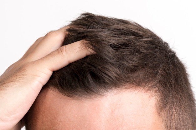 A New Consequence of Covid-19: Hair Loss