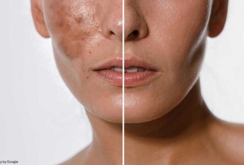 best for melasma