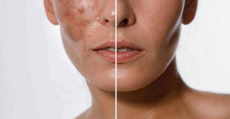 best for melasma