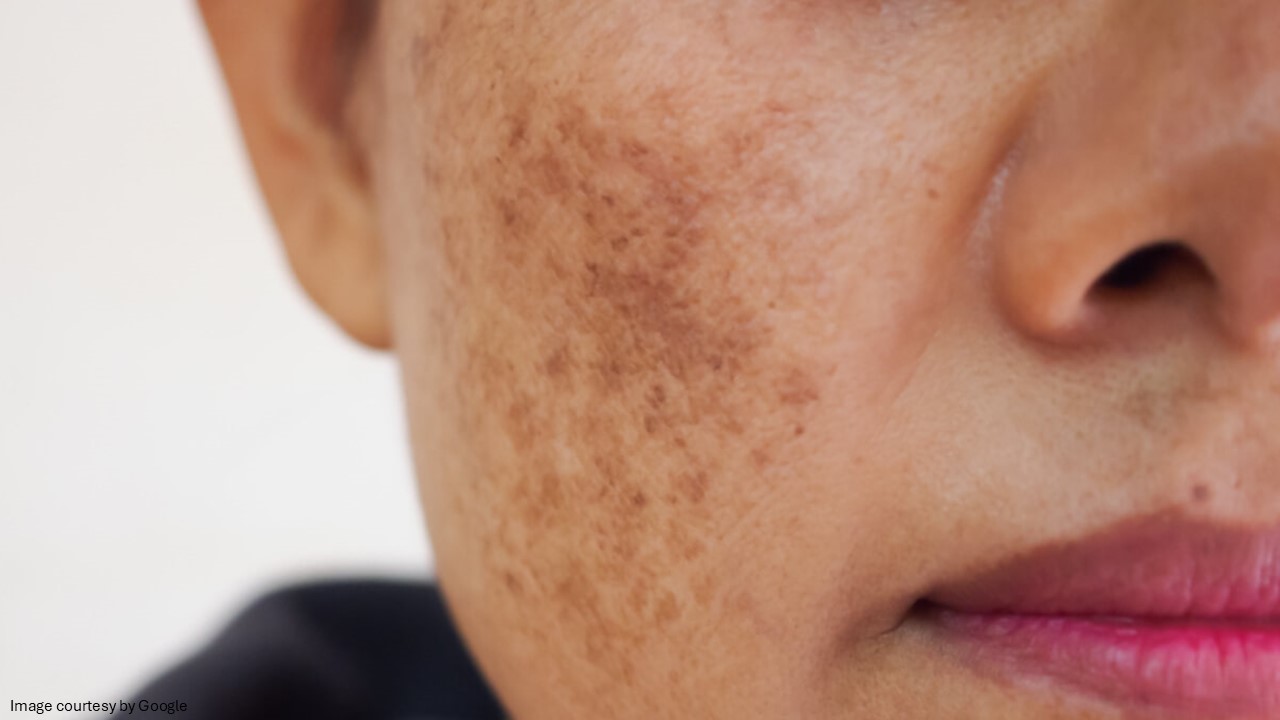 best hydroquinone cream for melasma