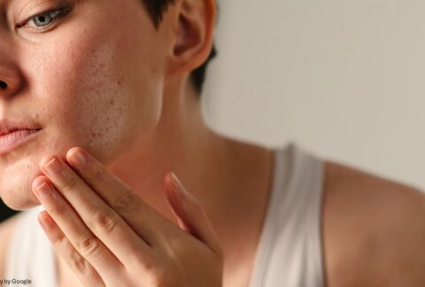 acne skin care​ - ADC