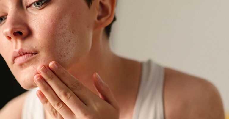 acne skin care​ - ADC