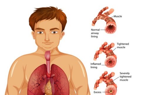 asthma