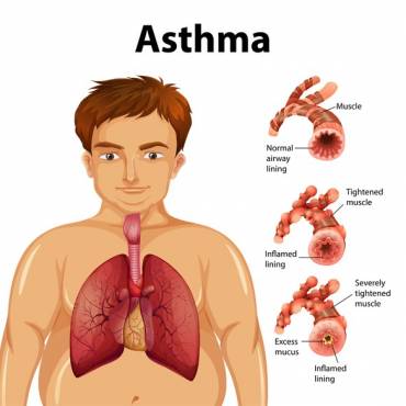Asthma Triggers and What to Do About Them