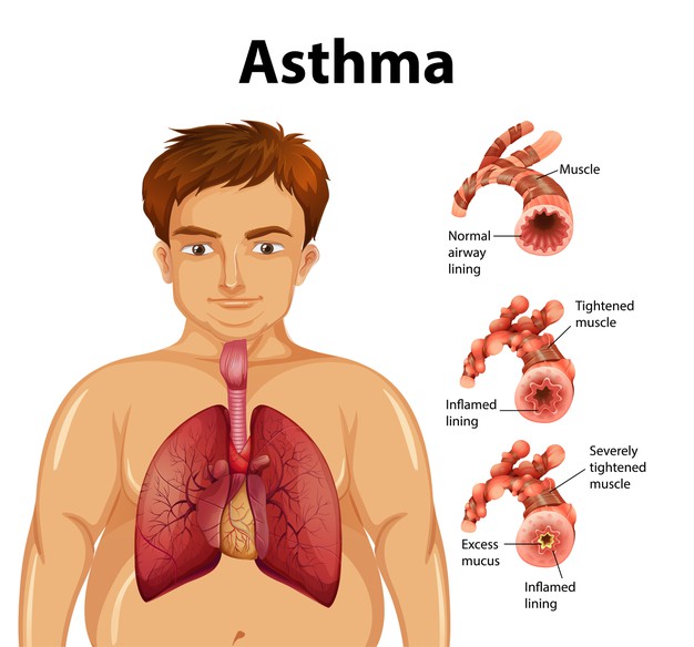 Asthma Triggers and What to Do About Them