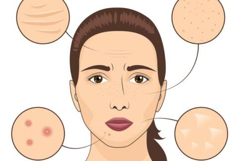 acne scars