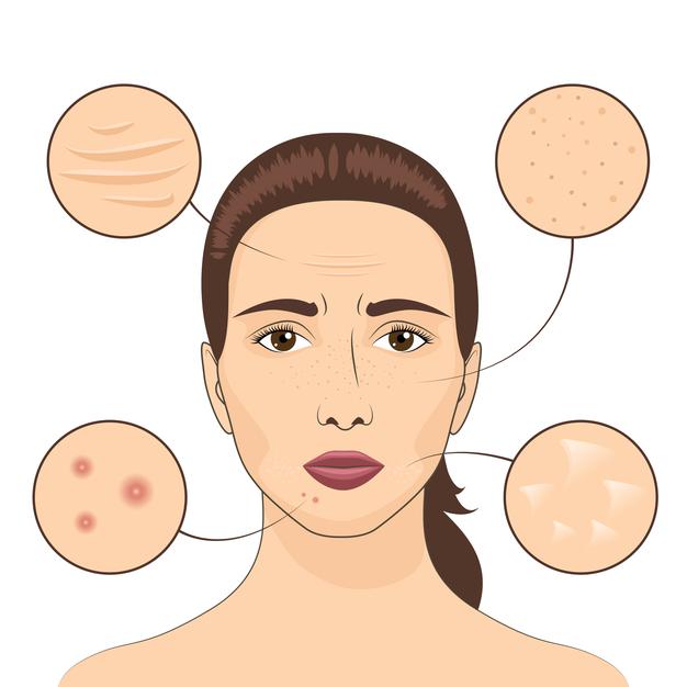 acne scars