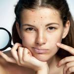 How to Clear Severe Acne?