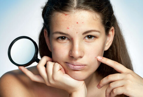 How-to-Clear-Severe-Acne-Image
