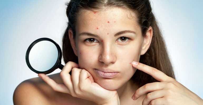 How-to-Clear-Severe-Acne-Image