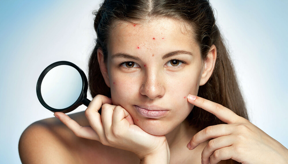 How to Clear Severe Acne?