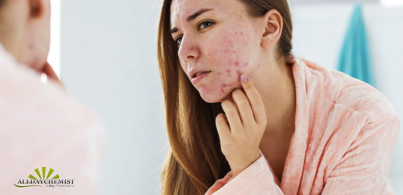Severe Acne Skin