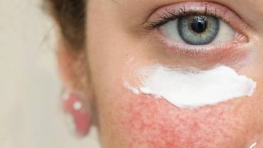 How Does Retin A Work? And How Does Retin A Help Your Skin?