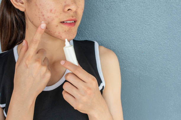 best acne treatment
