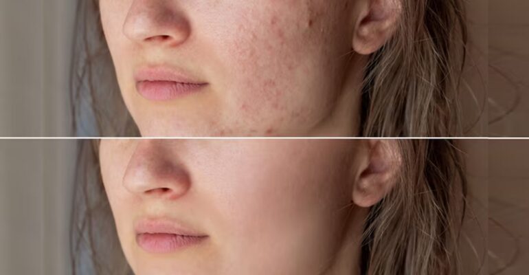 skin care for pimples