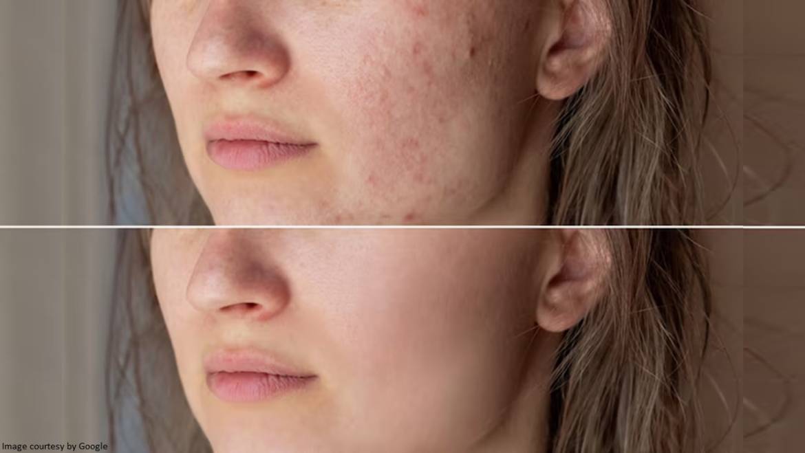 Best Acne Treatment for Different Types of Skin