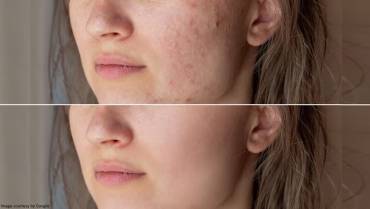 Best Acne Treatment for Different Types of Skin