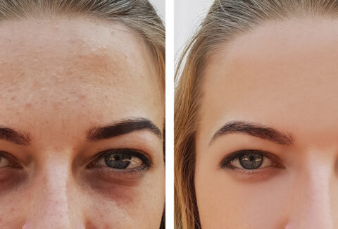 eye girl bag under the eyes before and after