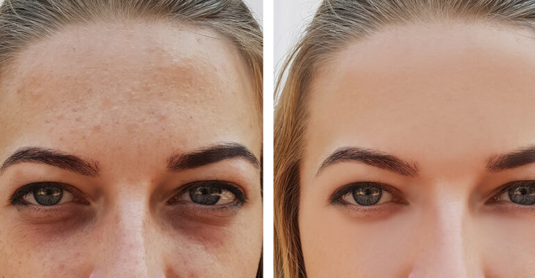 eye girl bag under the eyes before and after