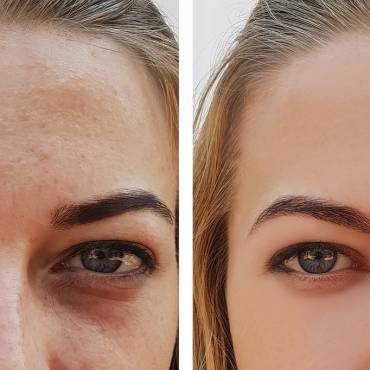 How To Get Rid of Dark Spots on Your Skin?