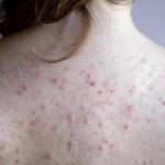 How To Get Rid of Body Acne?