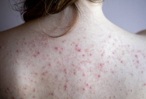 woman back with acne