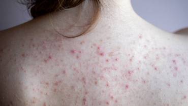 How To Get Rid of Body Acne?