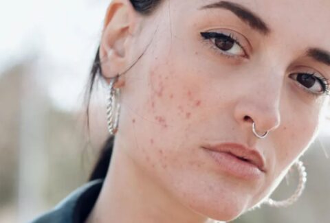 Things to know about Acne and Acne Scars