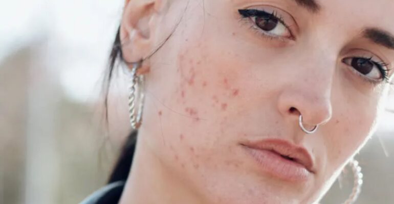 Things to know about Acne and Acne Scars