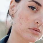 Things to know about Acne and Acne Scars