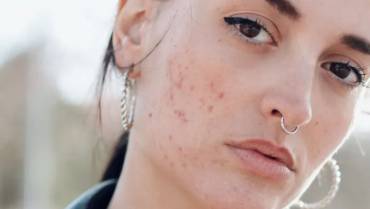 Things to know about Acne and Acne Scars