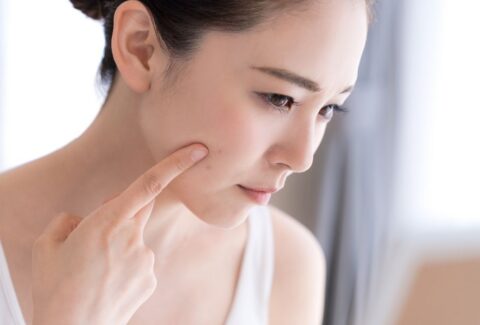 What is Hormonal Acne, & Its Treatment