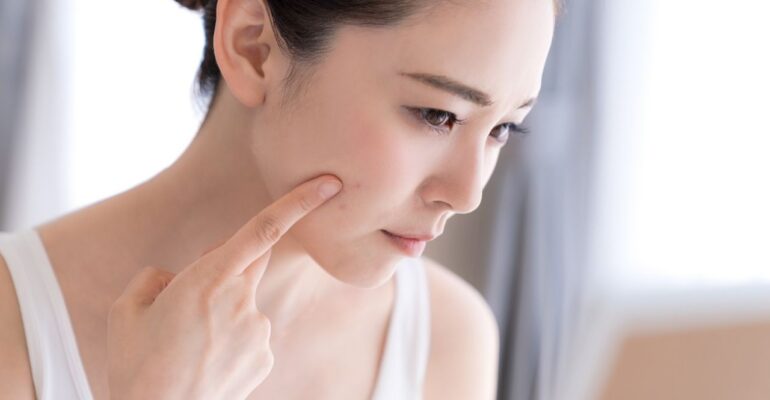 What is Hormonal Acne, & Its Treatment