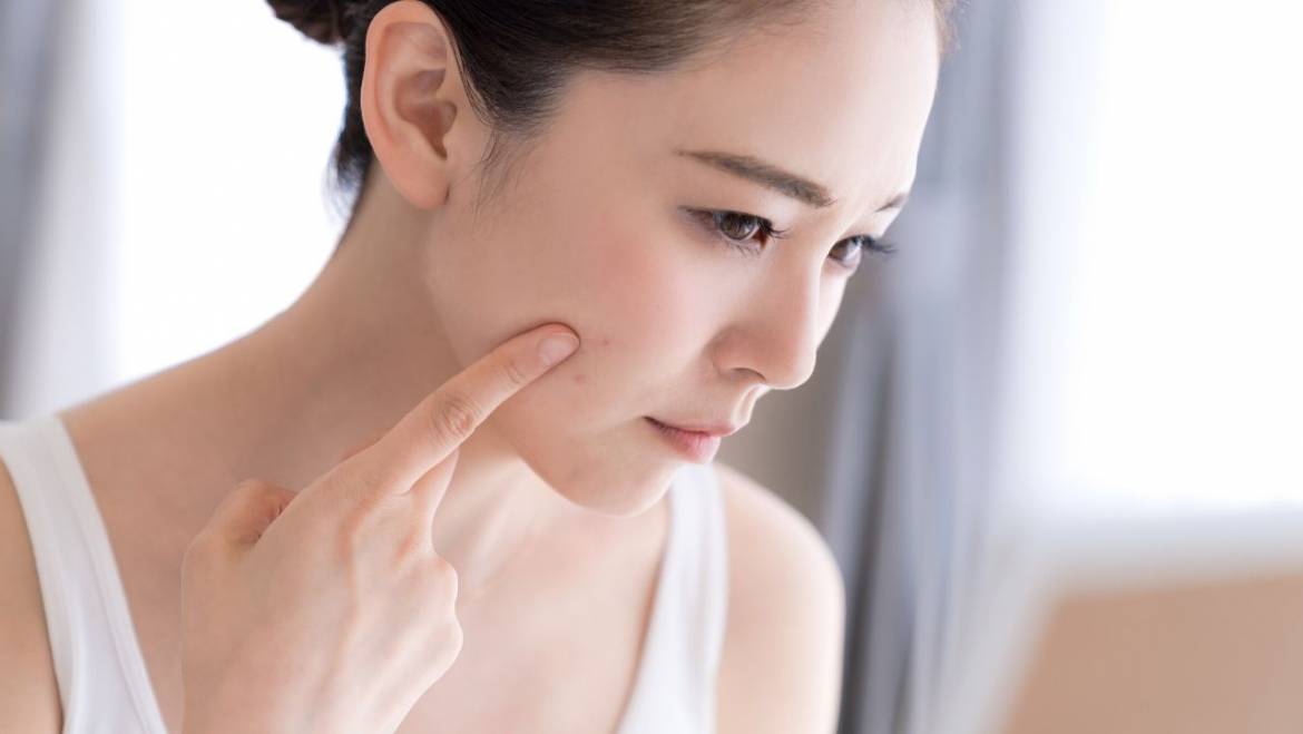 What is Hormonal Acne? Treatment, Causes & Prevention!