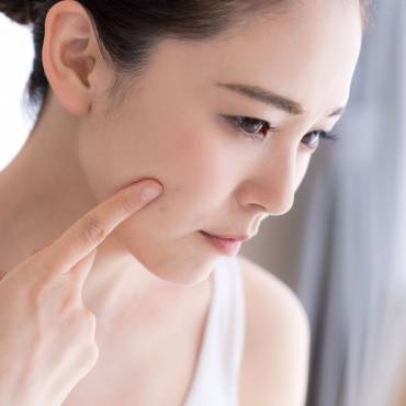 What is Hormonal Acne? Treatment, Causes & Prevention!
