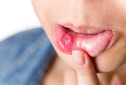How to treat a cold sore?