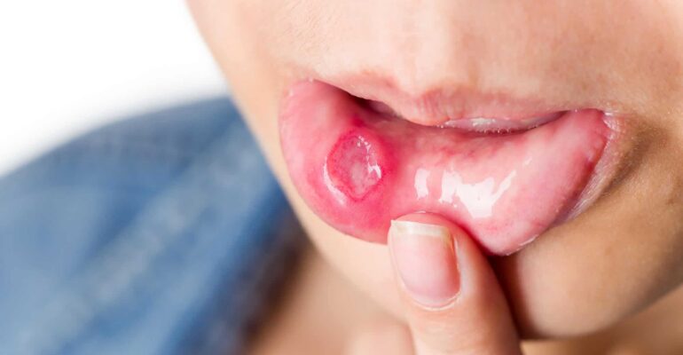 How to treat a cold sore?