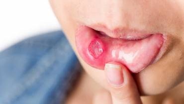 How To Treat A Cold Sore?