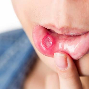 How To Treat A Cold Sore?