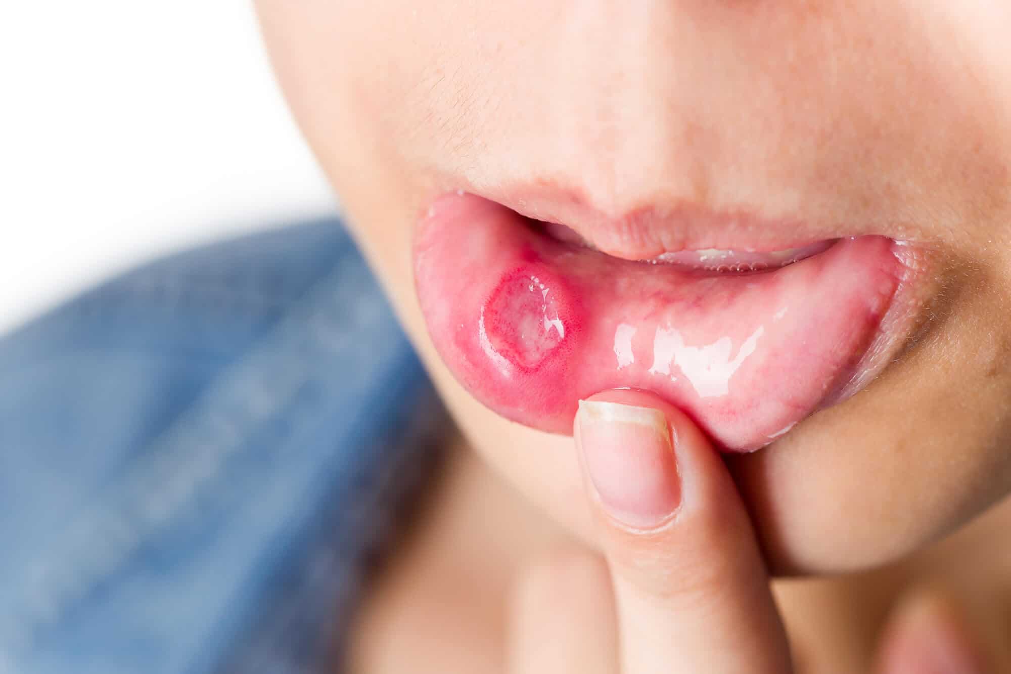 How to treat a cold sore?